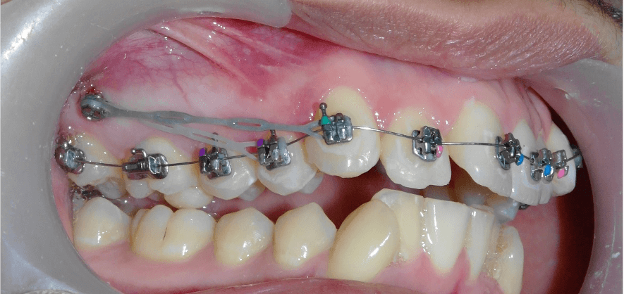 ORTHODONTISTE MINI VIS 1 ORTHODONTISTE MINI VIS 1