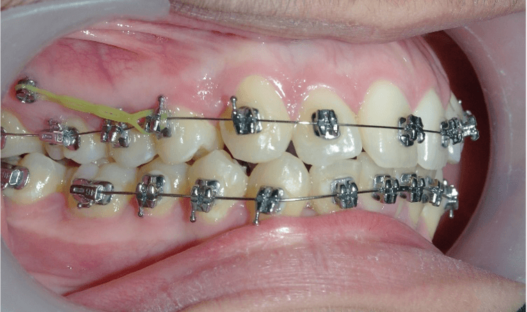 ORTHODONTISTE MINI VIS 2 ORTHODONTISTE MINI VIS 2