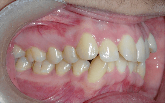 Orthodontie mini vis 1 Orthodontie mini vis 1